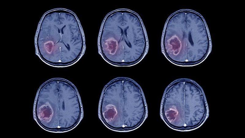 Brain scan of stroke victim