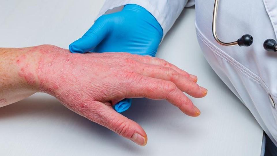 chronic hand eczema 