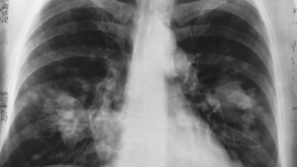 X-Ray of chest cavity and lungs