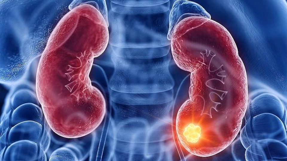 Boehringer drug scores in rare kidney disease FSGS