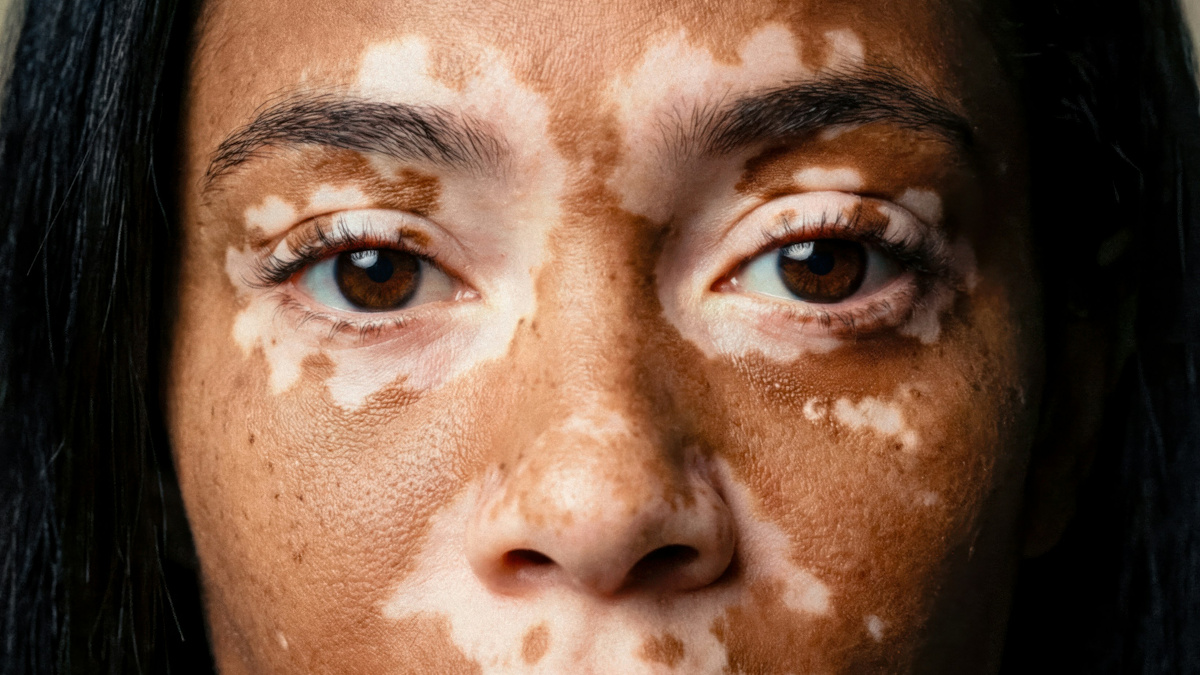 Joy as NICE changes tack on first NHS vitiligo treatment