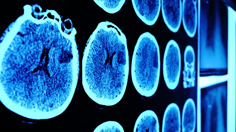 Bringing awareness to Brain Tumour Month, personally