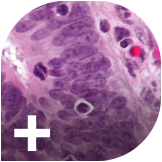 Biosimilars unlock use of bevacizumab in bowel cancer by NHS