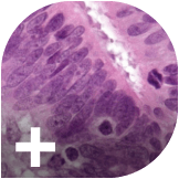Why is colorectal cancer rising in younger age groups?