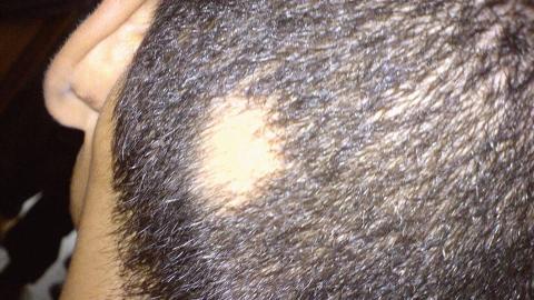 alopecia