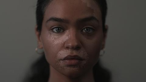 Vitiligo