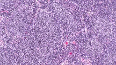  Micrograph showing a small B-cell lymphoma compatible with follicular lymphoma