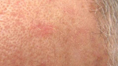 Close-up view of an actinic keratosis lesion