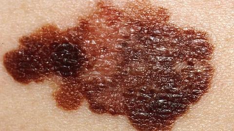 Close-up image of a melanoma on the skin