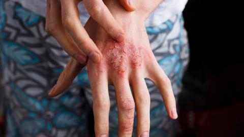 atopic dermatitis