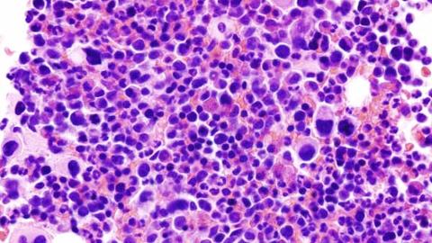 Histopathological image representing a bone marrow aspirate in a patient with essential thrombocythemia