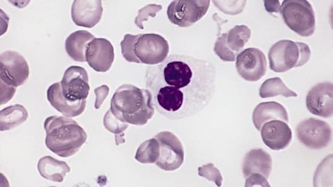 Blood smear from a person with myelodysplastic syndrome