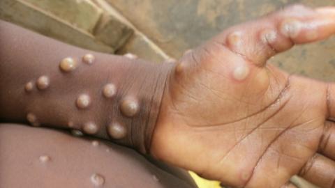 wrist and hand with mpox