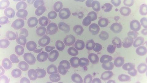 Beta thalassaemia cells