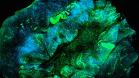 Ovarian tumour microenvironment