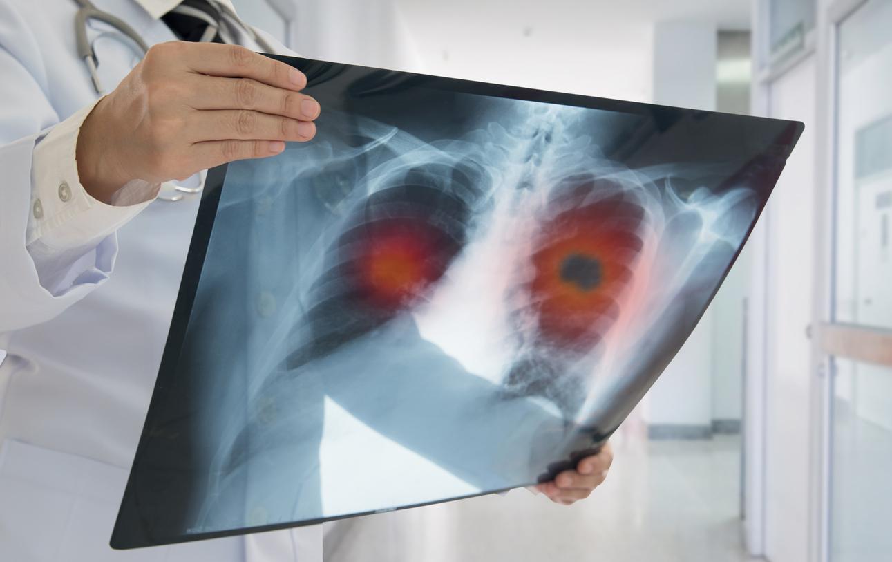 AZ cancer drugs chalk up wins in early-stage lung cancer