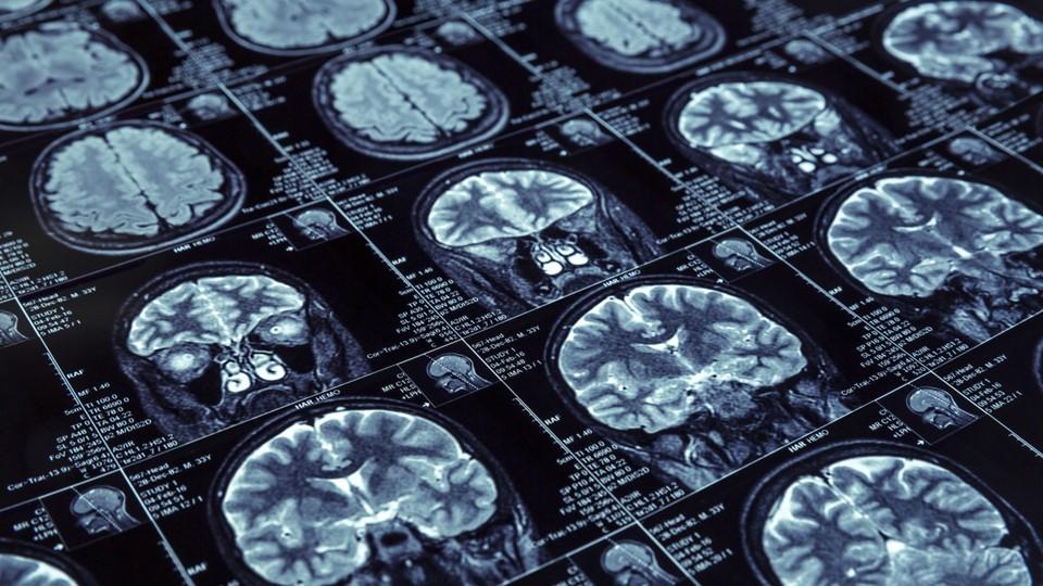 Donanemab data an “important advance” in Alzheimer’s