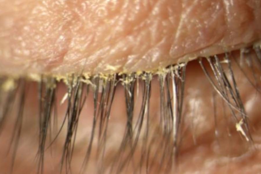 Demodex Blepharitis | Pharmaphorum