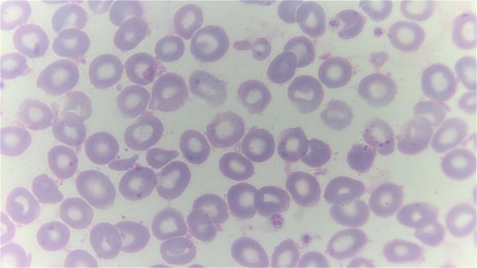 A giemsa stained blood smear from a person with beta thalassaemia