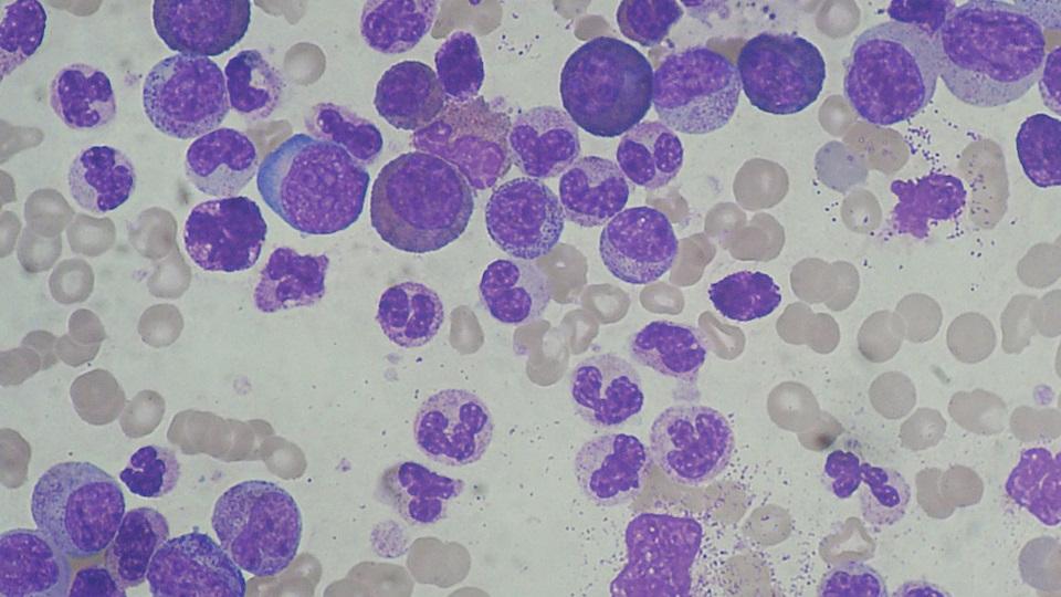 Chronic myeloid leukaemia smear