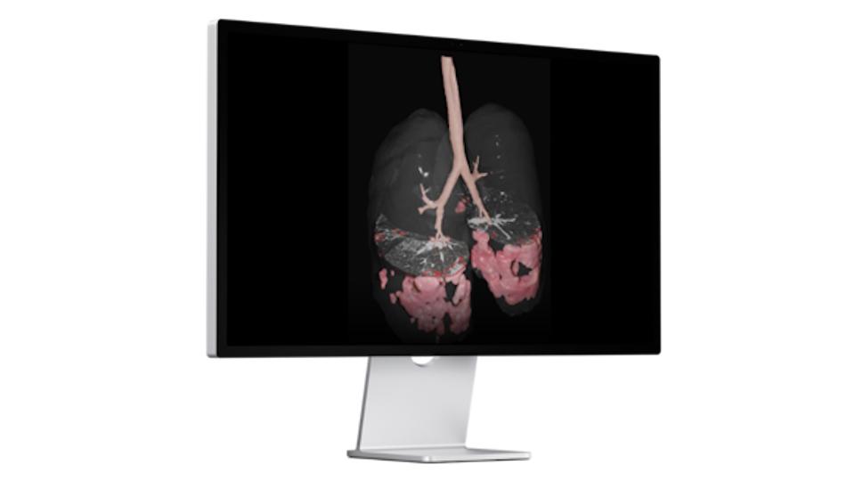 Lung disease imaging AI from Brainomix gets FDA nod