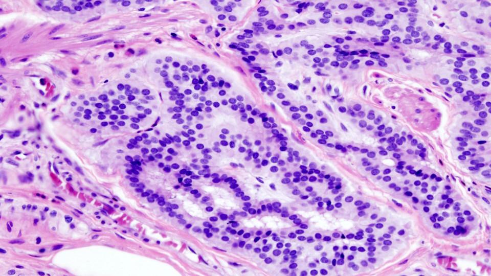Histopathologic image of colonic carcinoid stained by hematoxylin and eosin.