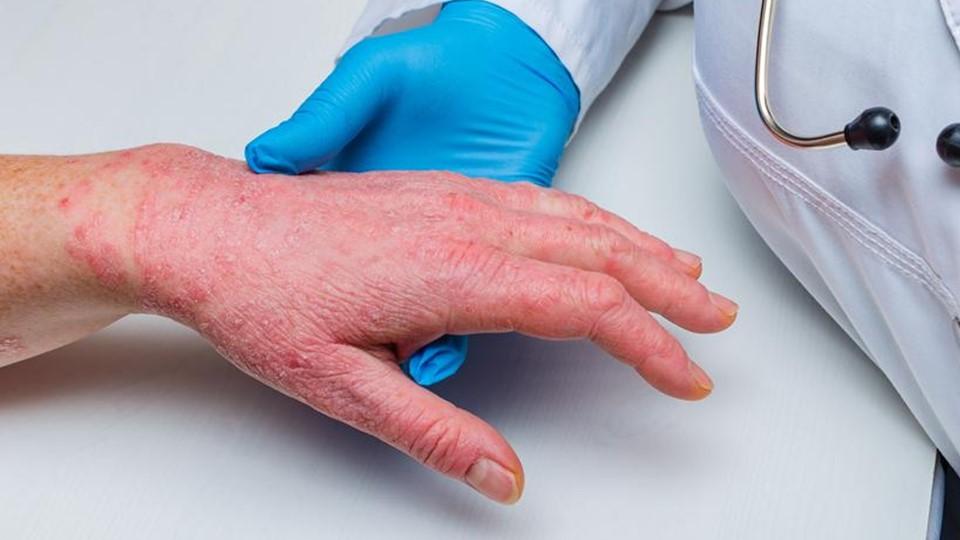 physician holds hand of a person with chronic hand eczema