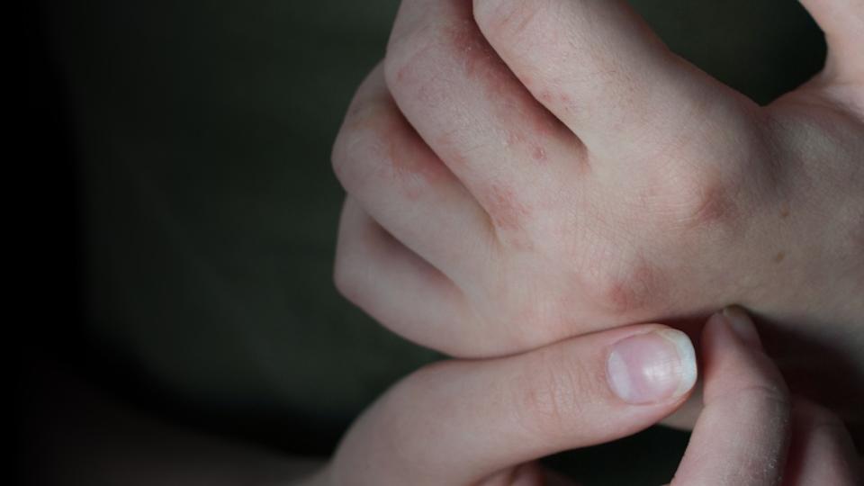 Survey reveals heavy burden of chronic hand eczema