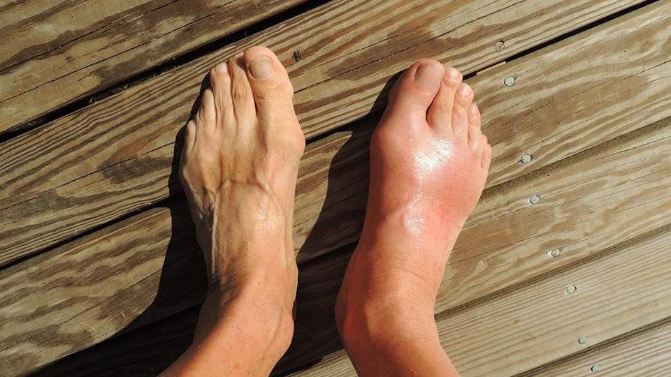 refractory chronic gout