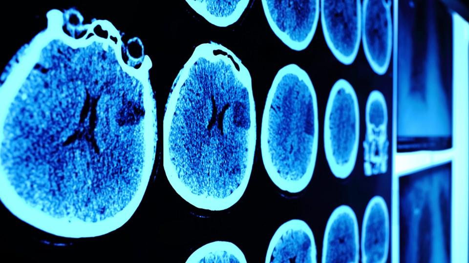 Skull CT scan of brain tumour