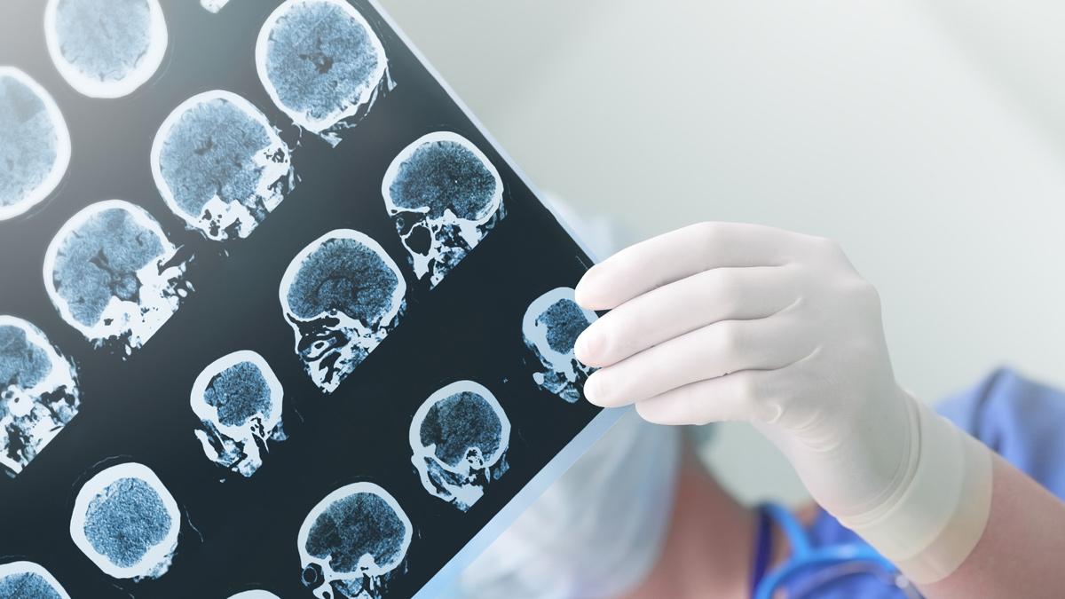 Most patients "won't see benefit" with Alzheimer's drugs