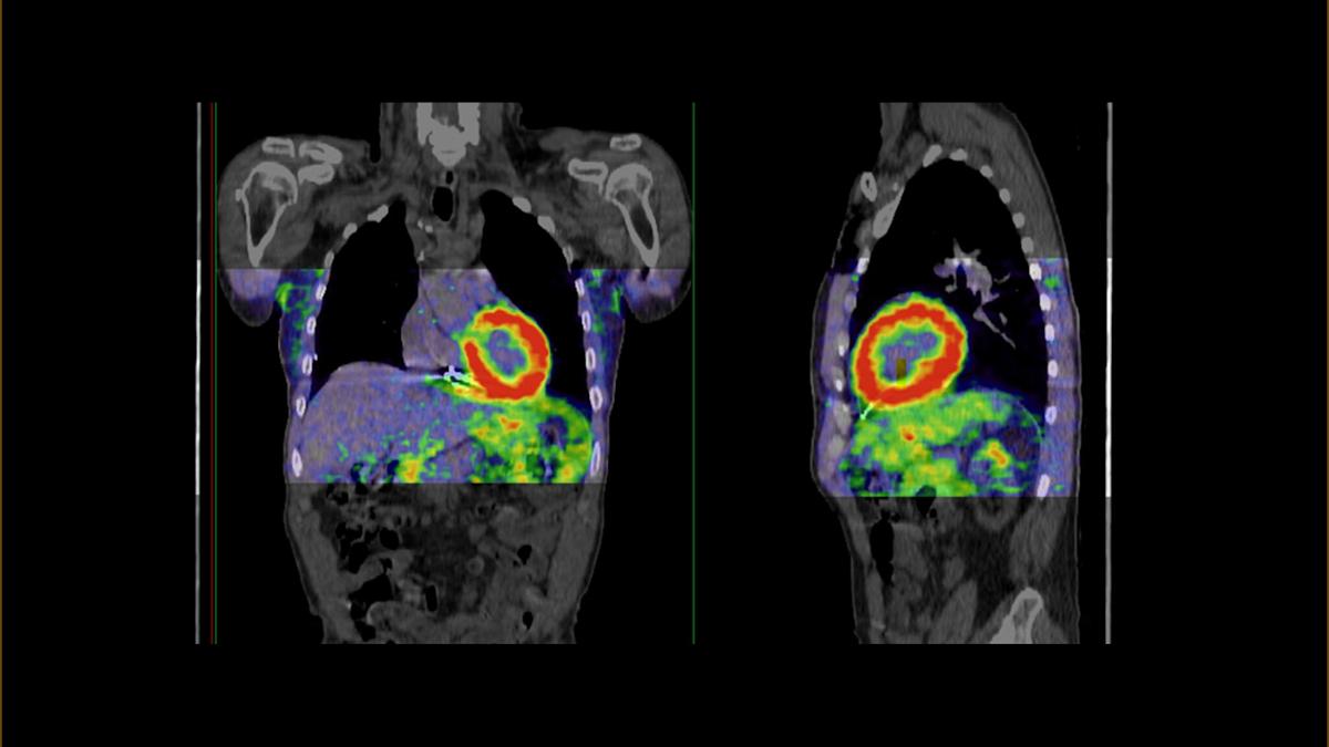 Radiotracer-enhanced PET/CT scan