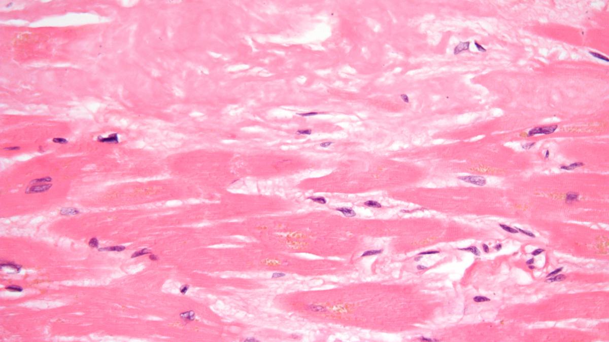 cardiac amyloidosis