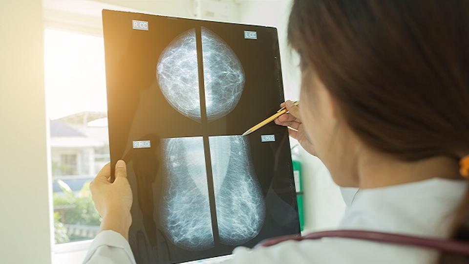 ASCO26: DNA test could spare breast cancer patients chemo