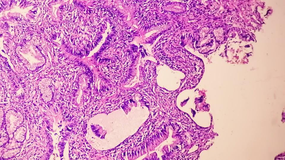 prostate cancer microscopic image of adenocarcinoma