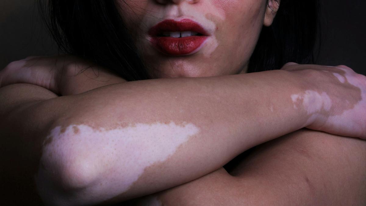 Pfizer cues up vitiligo filing for Litfulo after phase 3 win