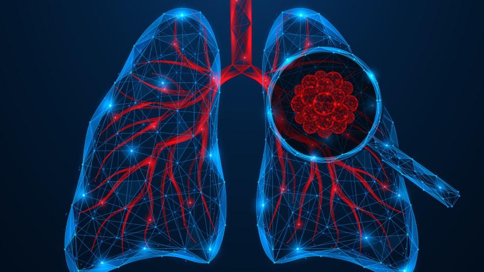 lung cancer