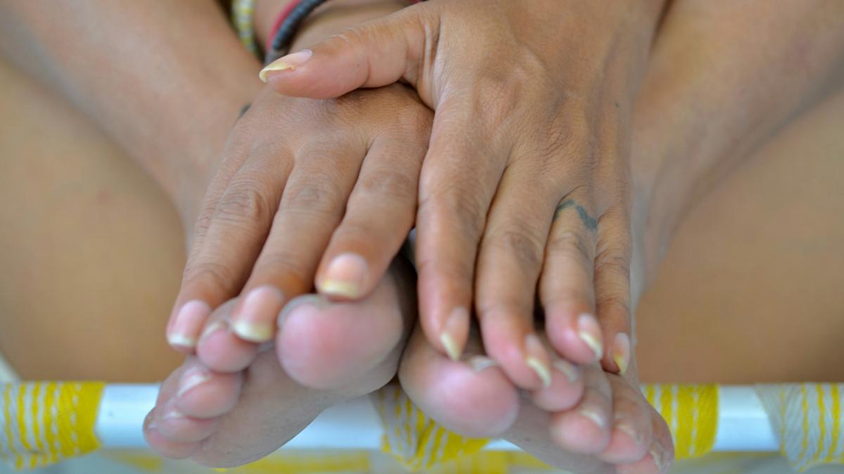 Keenova eyes Xiaflex as first drug for plantar fibromatosis