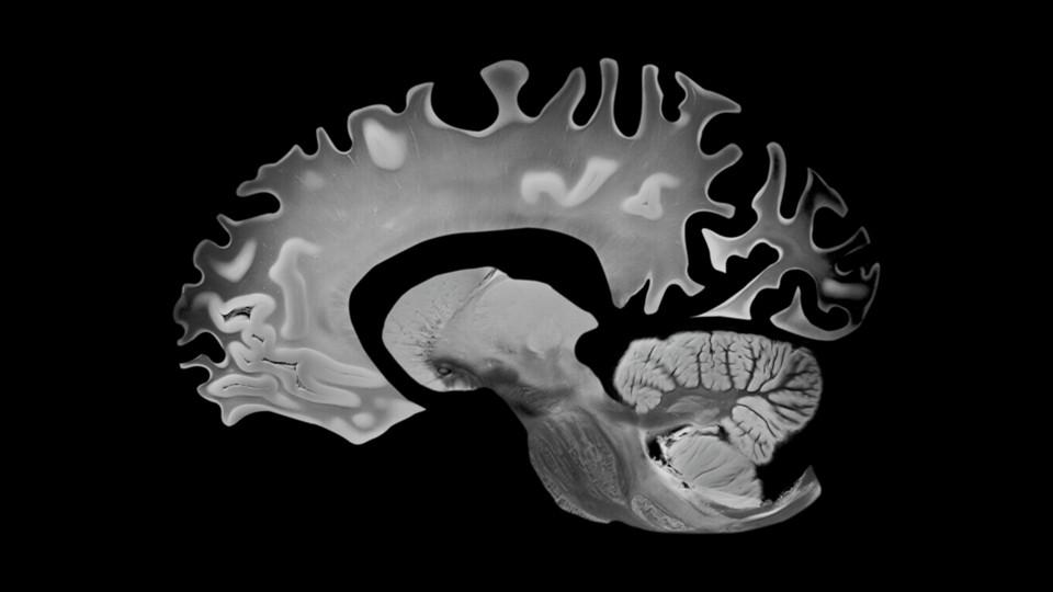 Alzheimer's brain, sagittal view