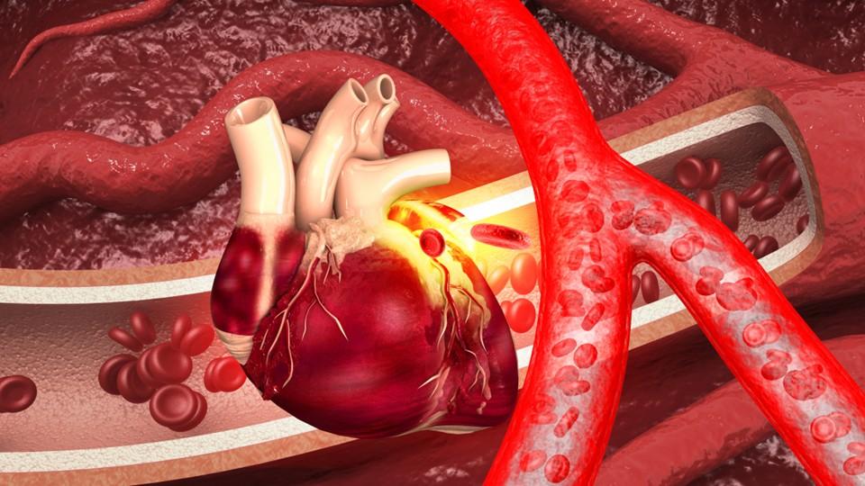 Heart with clogged arteries