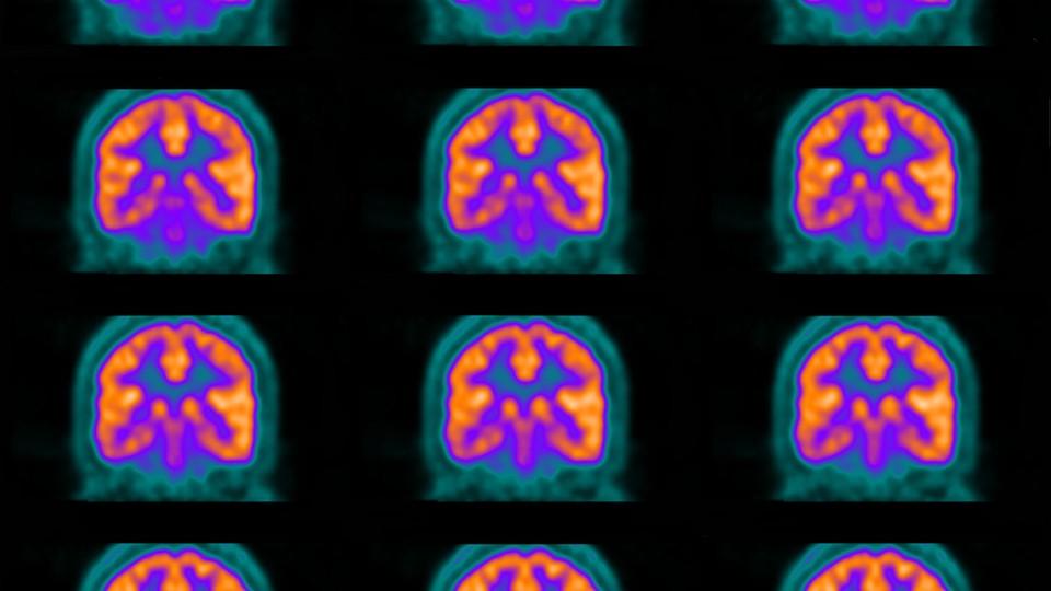 PET scans