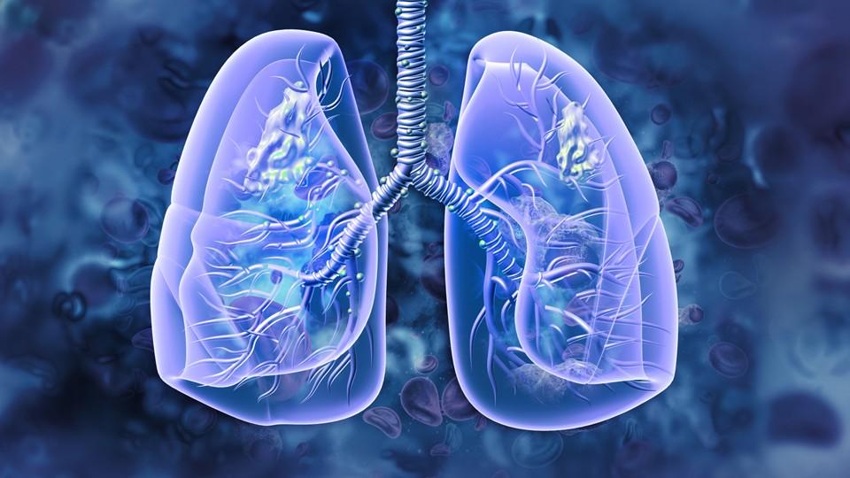 lung cancer-diseased lungs