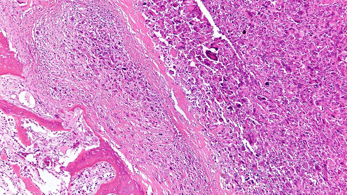 osteosarcoma image