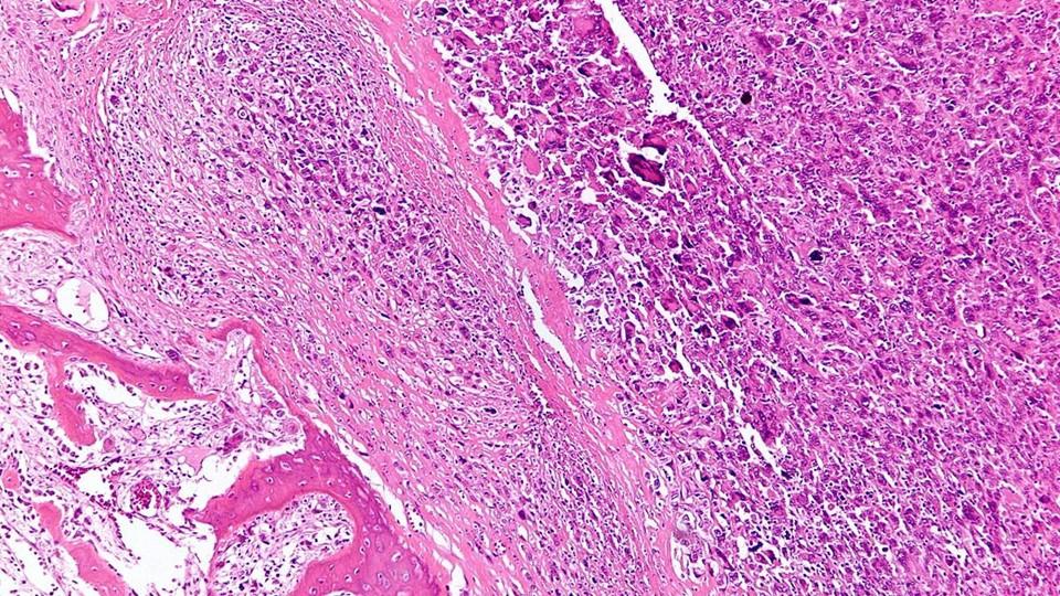osteosarcoma image