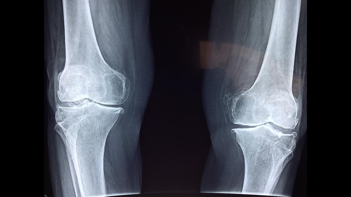 AZ makes case for hypophosphatasia drug after phase 3 miss