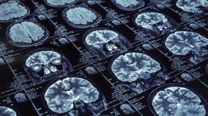 Certain brain tumours could respond to immunotherapy