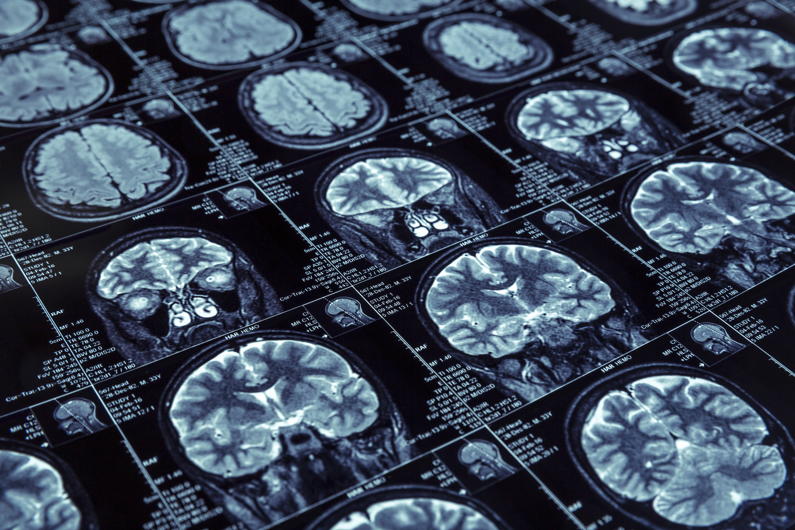 Donanemab data “strongest yet” in Alzheimer’s