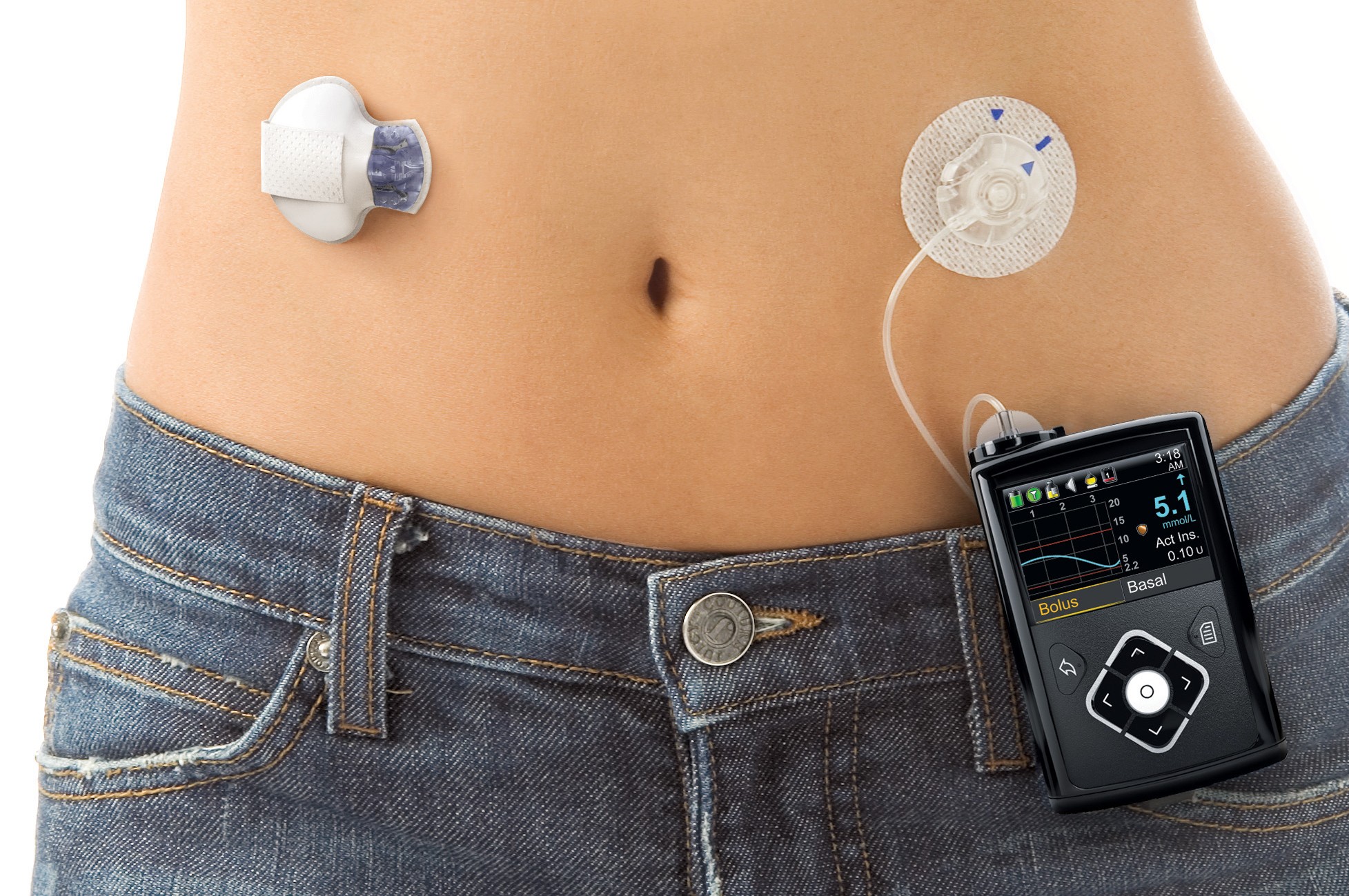 Diabetes Insulin Pumps & Patches: What Are They