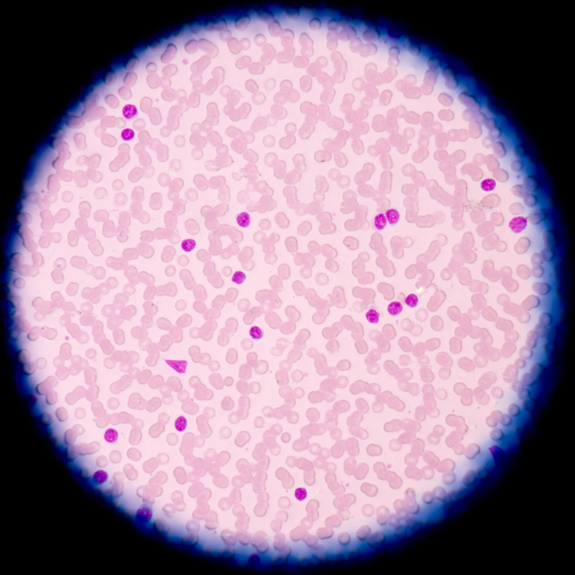 Chronic lymphocytic leukemia (CLL) is a type of cancer of the blood and bone marrow - the spongy tissue inside bones where blood cells are made.