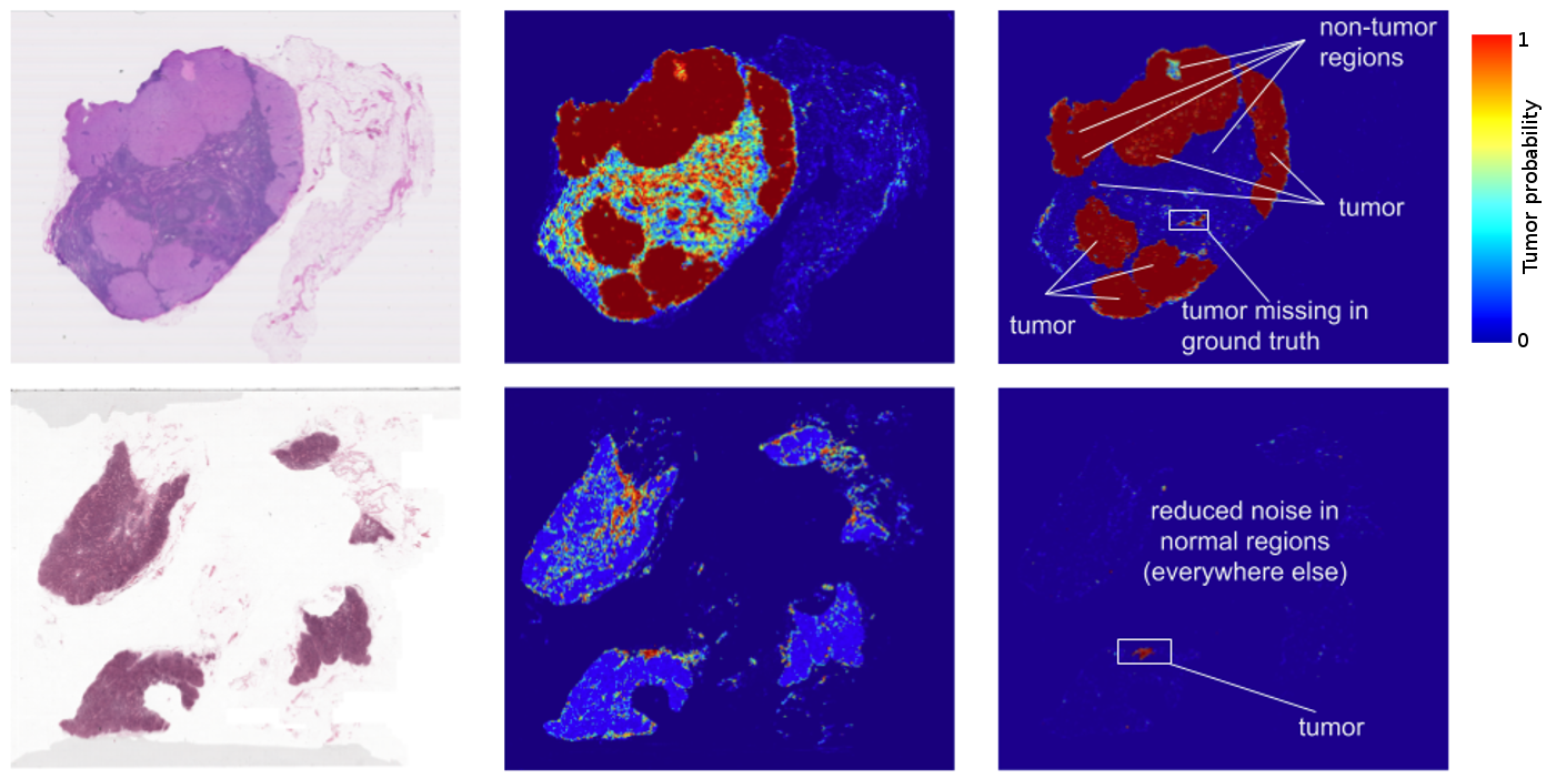 google-ai-detects-breast-cancer-better-than-pathologists-pharmaphorum